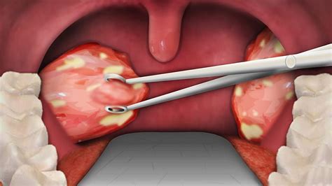 tonsillectomy nedir